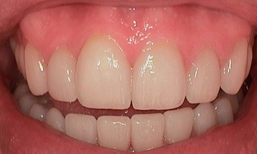 After full mouth reconstruction in Harley Street - 38 year old man 