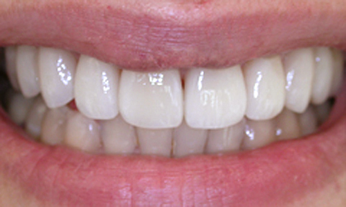 After dental veneers London