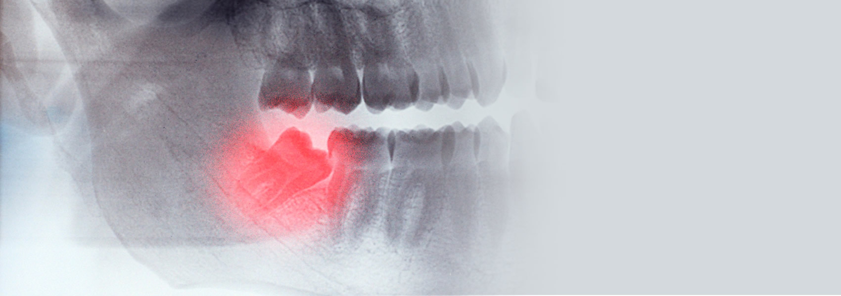 wisdom teeth removal costs in the UK