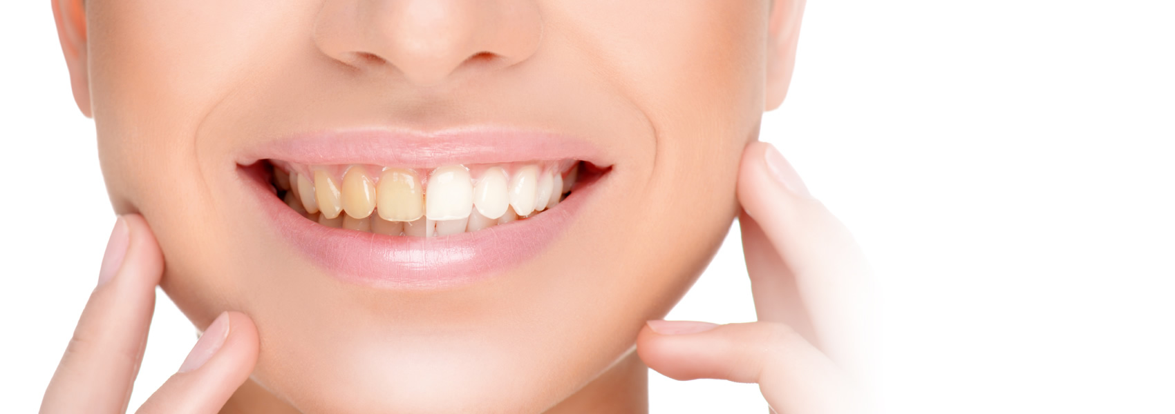 Best Teeth Whitening London