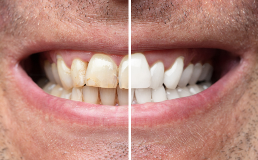 Examples of Teeth Whitening in Harley Street
