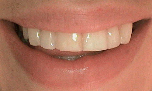 Before cosmetic bonding in Harley Street - 26 year old lady