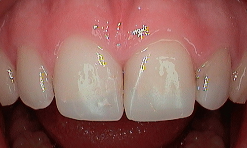 After cosmetic bonding in Harley Street - 16 year old