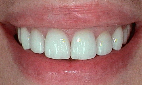 After dental crown fitted in Harley Street - 47 year old lady