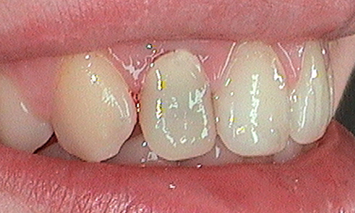 Before dental crown fitted in Harley Street - 21 year old lady