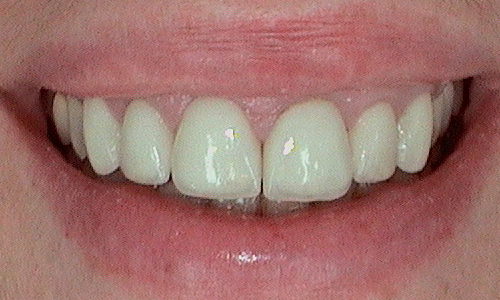 Before dental crown fitted in Harley Street - 47 year old lady