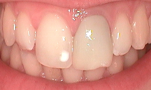 Before dental crown fitted in Harley Street - 22 year old lady