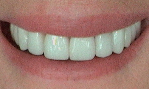 After dental crown fitted in Harley Street - 59 year old lady