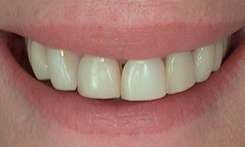 Before dental crown fitted in Harley Street - 59 year old lady