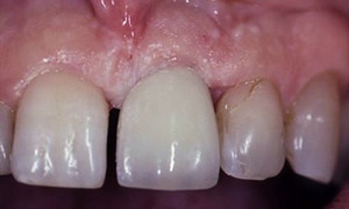 dental implants London UK after treatment at 75 Harley Street