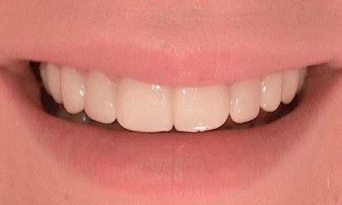 After full mouth reconstruction in Harley Street - 18 year old lady