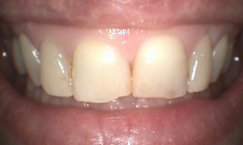 Before full mouth reconstruction in Harley Street - 46 year old lady