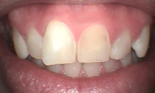 Before full mouth reconstruction in Harley Street - 38 year old man 