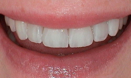 After veneer treatment in Harley Street - 39 year old lady