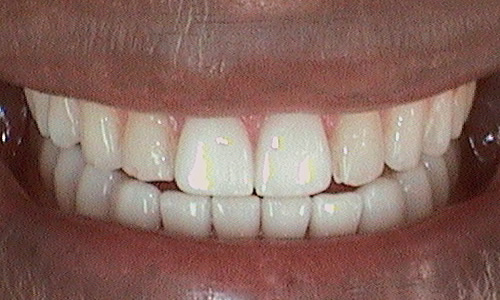 After porcelain veneers Harley Street - 42 year old diplomat