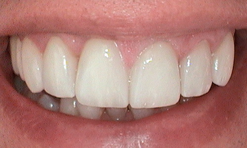 After veneers teeth treatment in Harley Street - 47 year old man