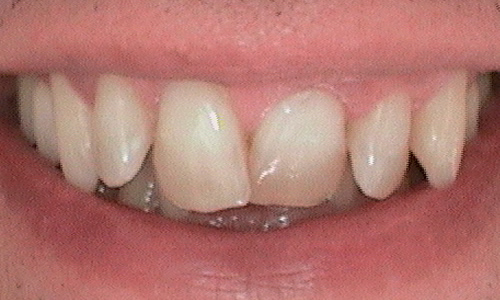 Before veneer treatment in Harley Street - 47 year old man