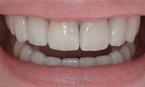 After veneer treatment in Harley Street - 62 year old lady