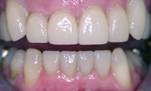 After dental veneers treatment