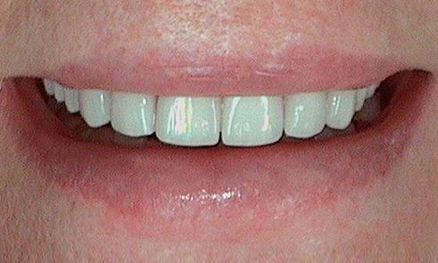 After veneer treatment in Harley Street - 83 year old lady