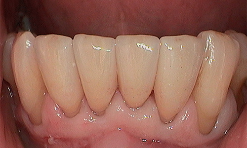 After veneer treatment in Harley Street - 64 year old man