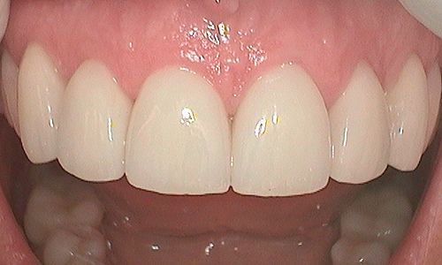 After veneer treatment in Harley Street - 46 year old lady