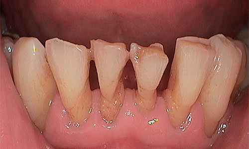 Before veneer treatment in Harley Street - 64 year old man