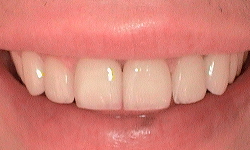 After veneer treatment in Harley Street - 27 year old man 