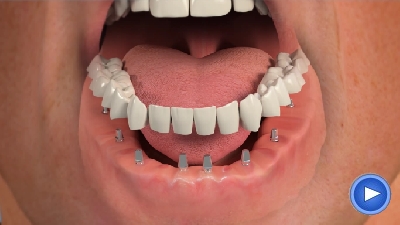 Full Mouth Implants